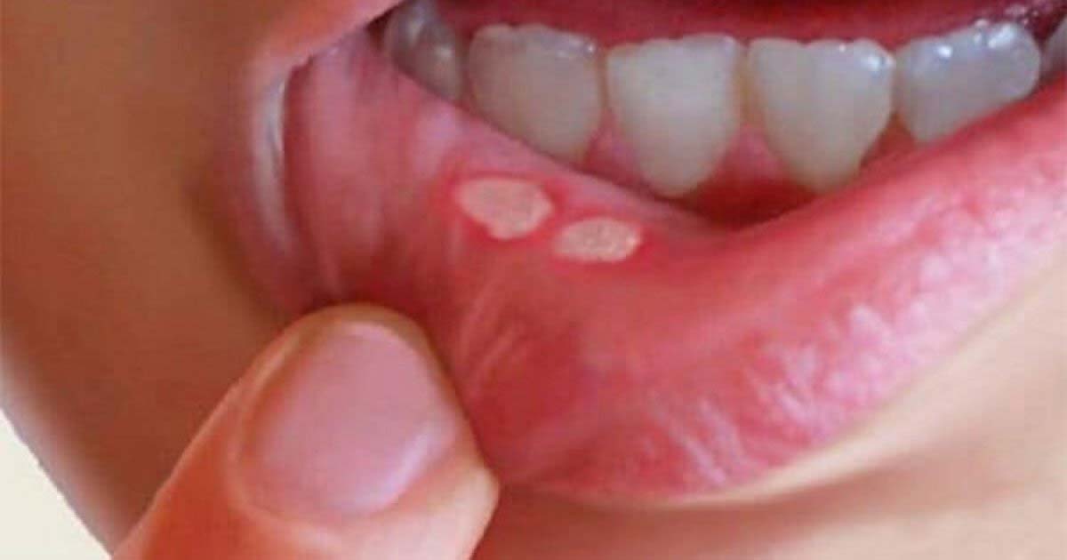মুখের ঘা কি সাধারণ সমস্যা নাকি সতর্কতার সংকেত?