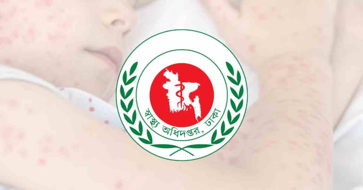 হামের প্রকোপ কমছেই না, মৃতের সংখ্যা ছাড়াল ৮০০